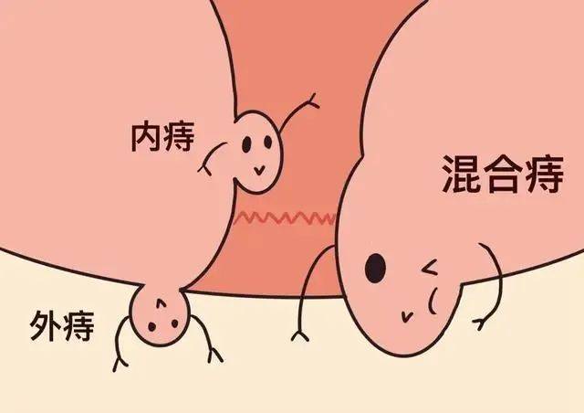 痔疮不疼不痒需要治疗吗一定要手术吗