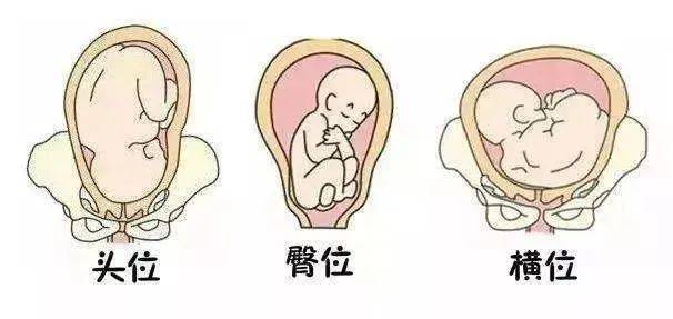 想要顺产这4个要素很关键助产士应该如何做又有哪些注意事项