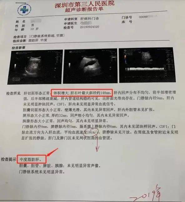 b超影像结果显示,肝脏右叶最大斜径148mm,比成人正常肝脏还要大.