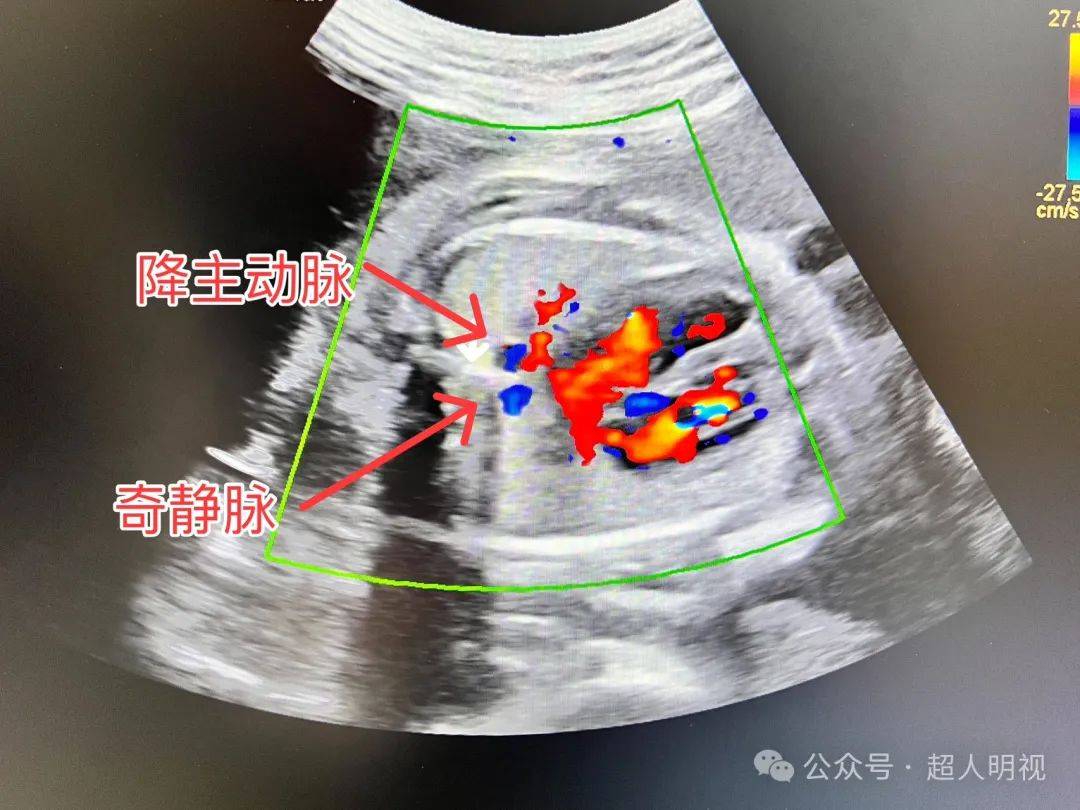 超声四腔心切面图片