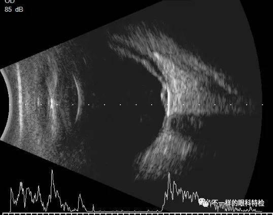 带您了解眼部b超