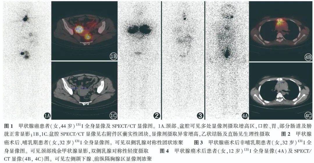 学术131i全身显像的真真假假