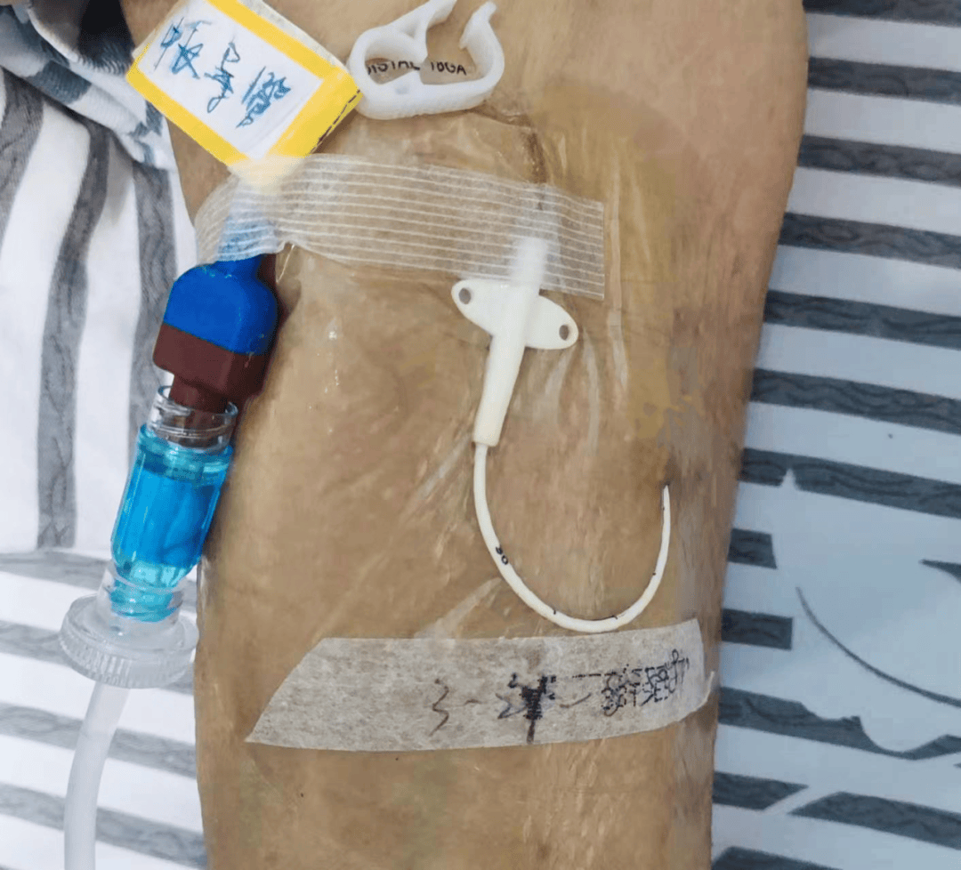 中长期住院只扎"一针",解决输液困难问题_护理_导管_患者