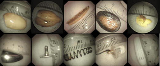 家长:肺炎治不好了?_异物_可乐_孩子