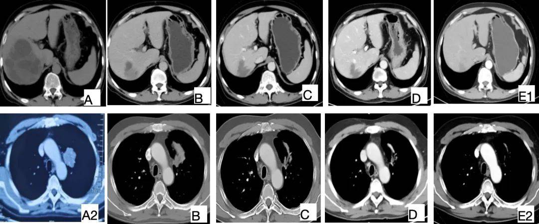 超声ctmripetct都说是肝包虫病是肺癌肝转移
