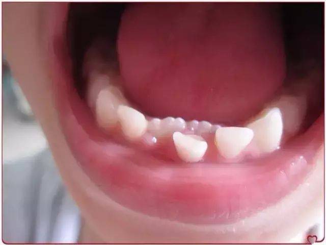 宝宝_牙齿_乳牙