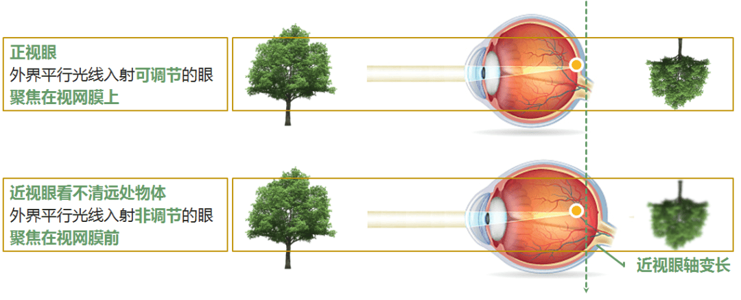 近视眼形成的原理图片