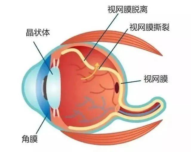 近视只是看不清吗不可能会致盲