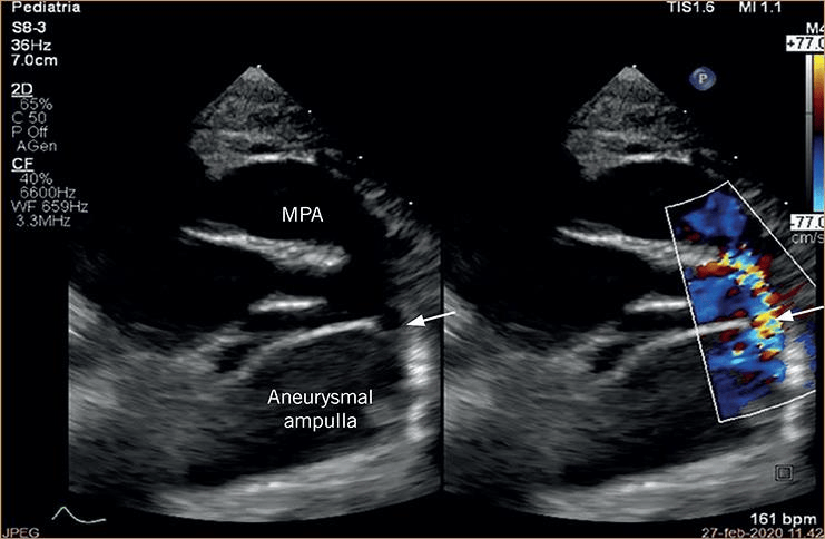 注意管状结构内皮上以及与肺动脉相通处周围的射流冲击损伤(箭头).