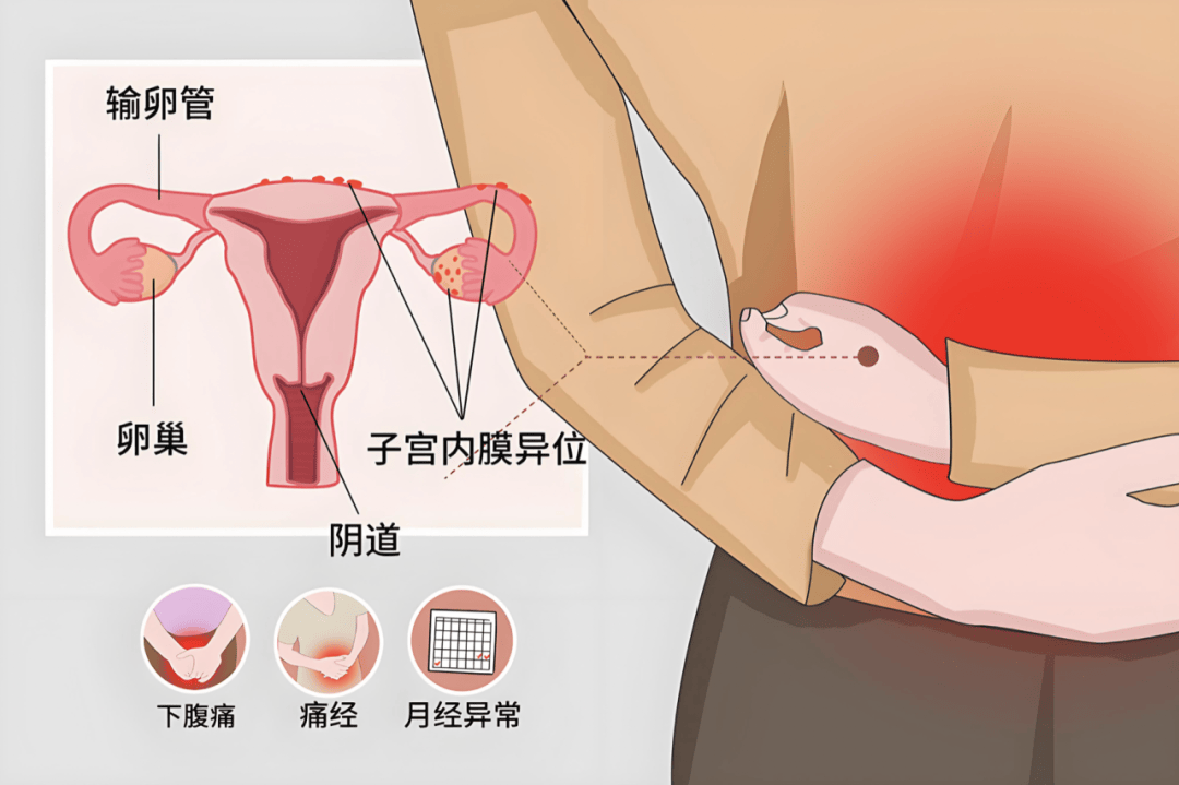 附件炎疼痛位置图图片