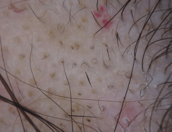 斑秃鬼剃头知多少