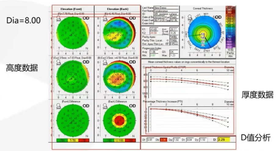 角膜地形图高度图分析图片
