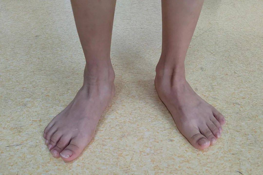 外翻足:与内翻足相反,外翻足是指足部向外翻折的现象.