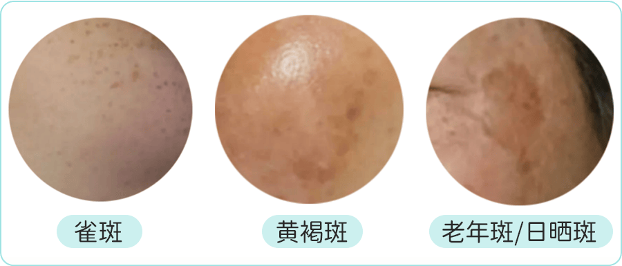 皮肤科大夫朱学骏●颧部褐青色痣:对称分布在颧部的黑灰色斑点状色素