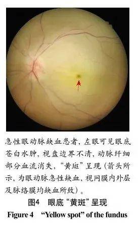 吴松笛教授关注血管神经眼科疾病概念诊疗方法及策略