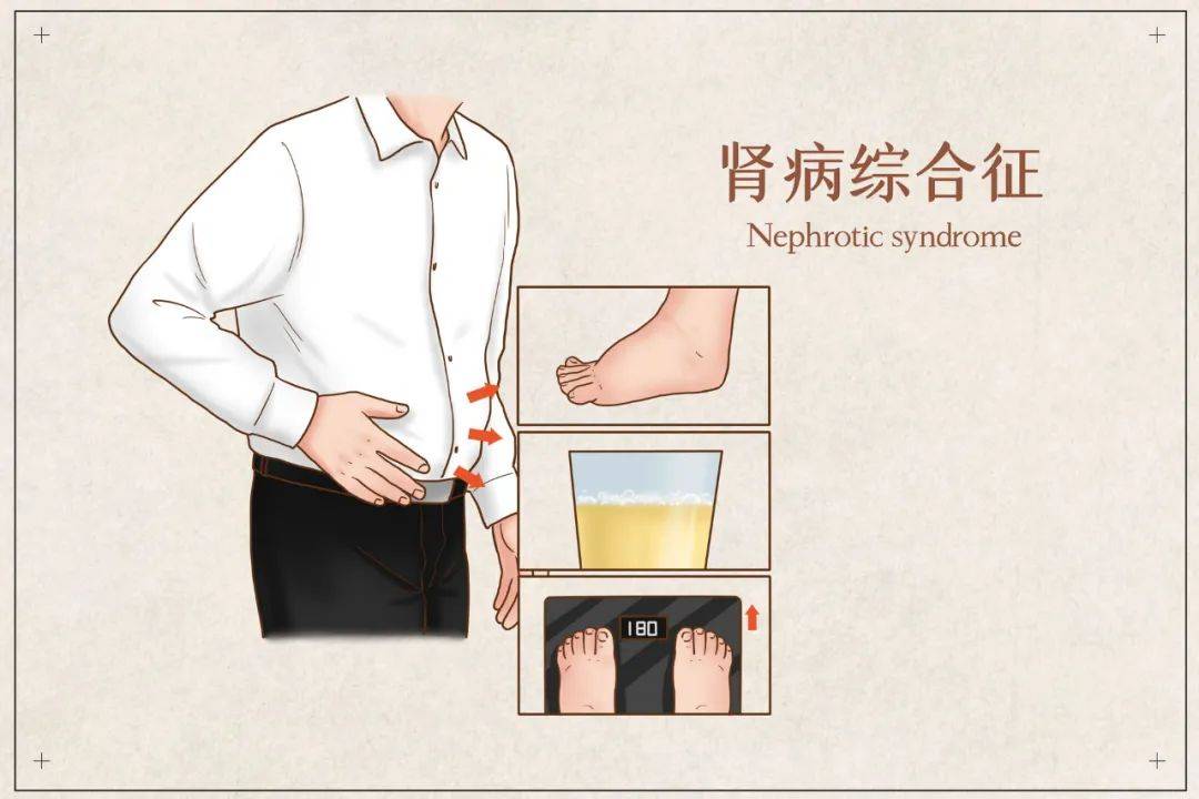 肾病综合症分为原发性与继发性?如何防治?_综合征_疾病_治疗