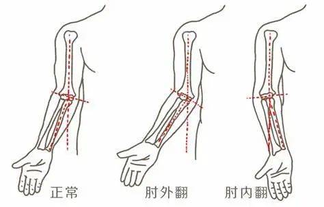 胳膊肘外翻怎么矫正图片