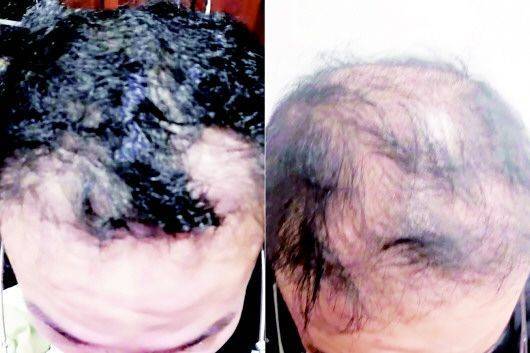 袁子义进行植发手术前后的头顶头发对比,左图拍摄于2022年1月初植发