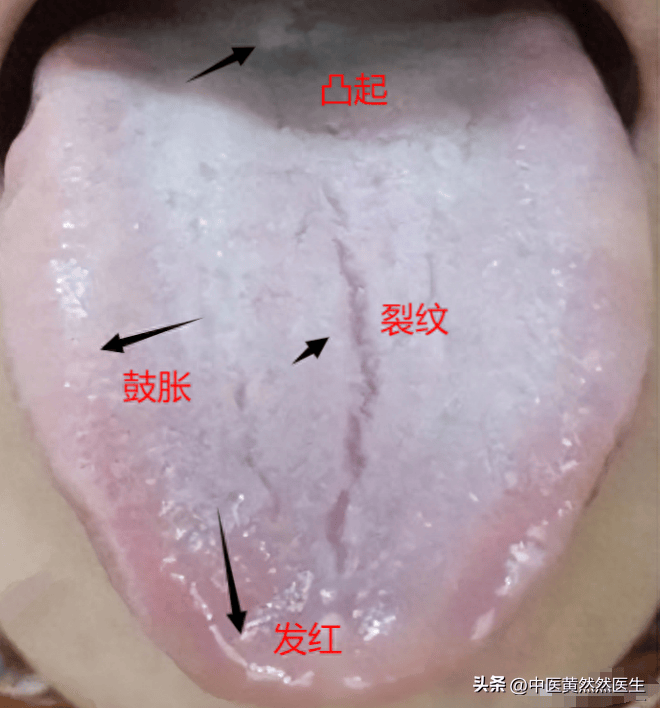 3,舌质越来越淡——血虚或是阳虚舌苔同时也是体内湿气,痰湿重的表现