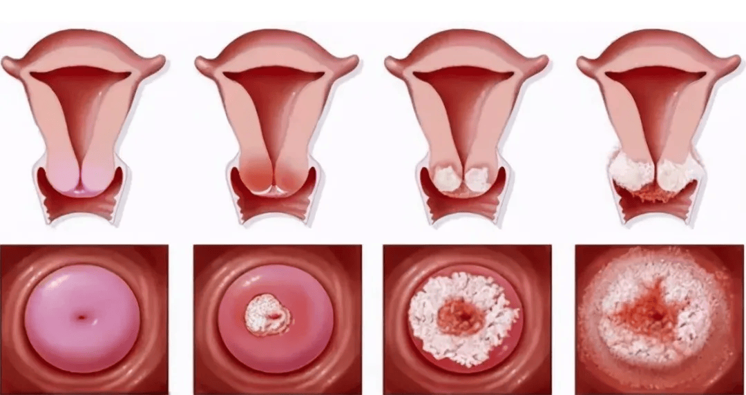 宫颈病变图片 图谱图片