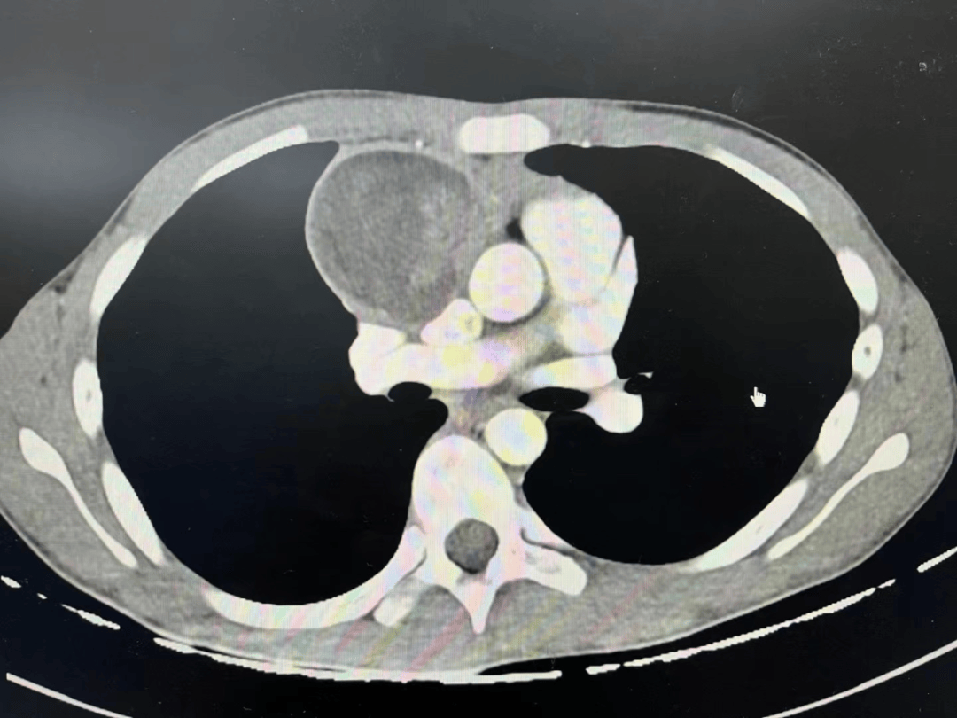 良性纵隔肿瘤图片图片
