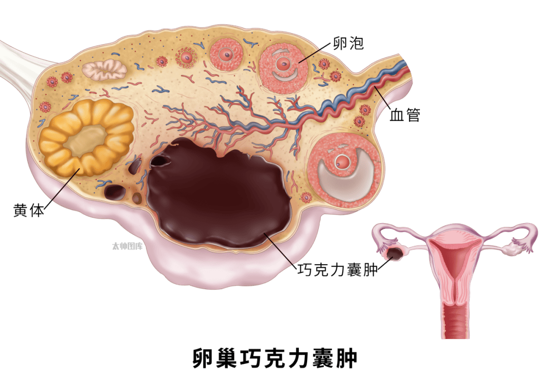 卵巢图片真实照片图片