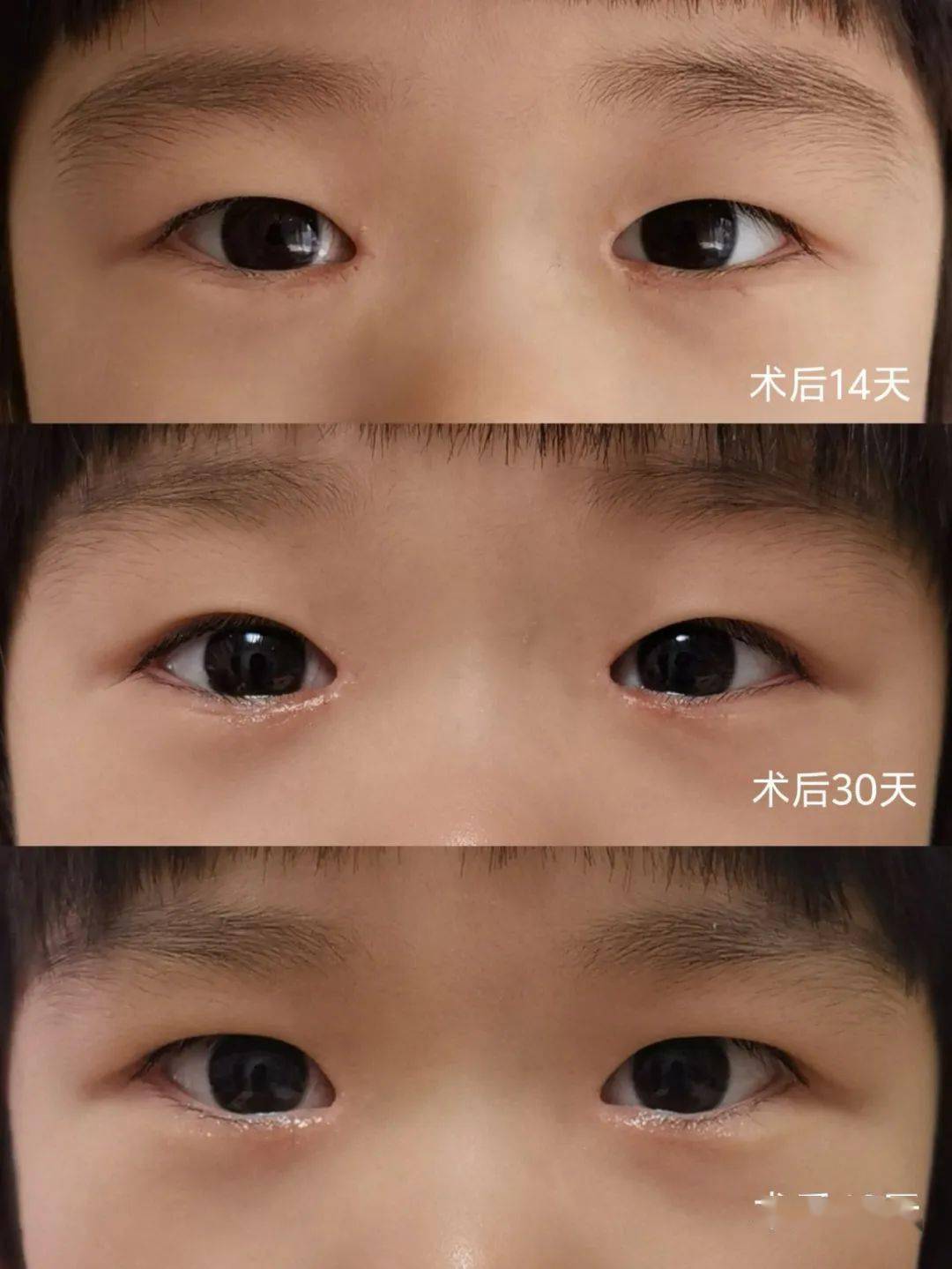 医生提醒:娃出现这个信号,家长一定要注意_孩子_眼睛_手术