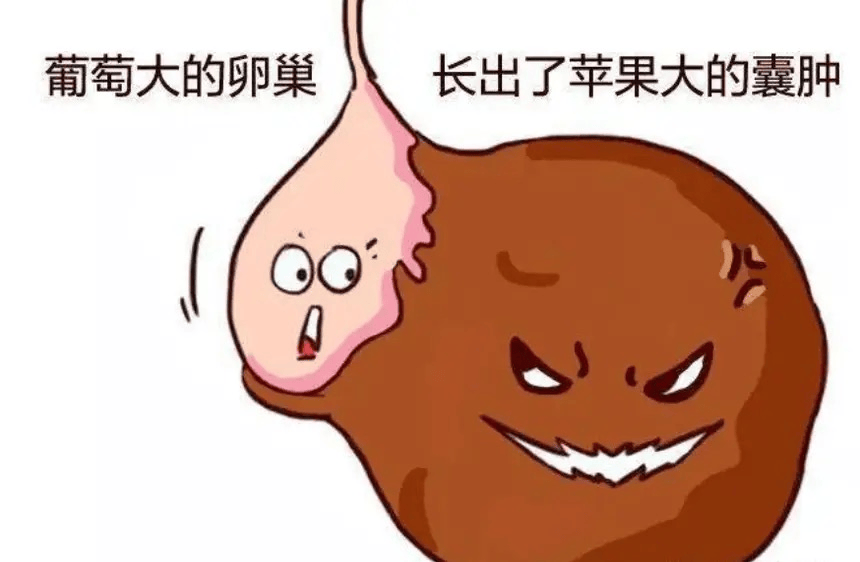 良性的卵巢囊肿常见的有卵巢子宫内膜异位囊肿(由于异位的子宫内膜在