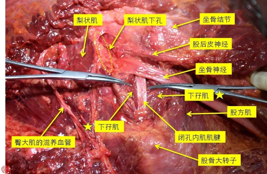 医学笔记︱15分钟掌握臀后入路的解剖步骤(锋哥推荐)