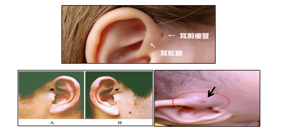 健康科普丨67揭秘耳朵周围的小孔——先天性耳前瘘管