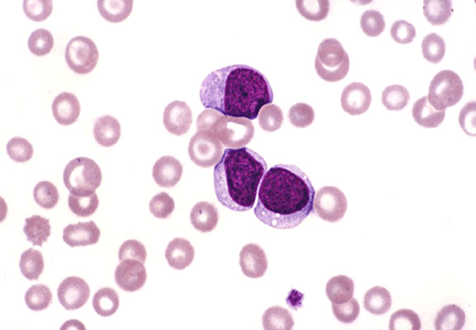 这3种白细胞肿瘤疾病的细胞学发现,临床意义与预后,你都掌握了吗?