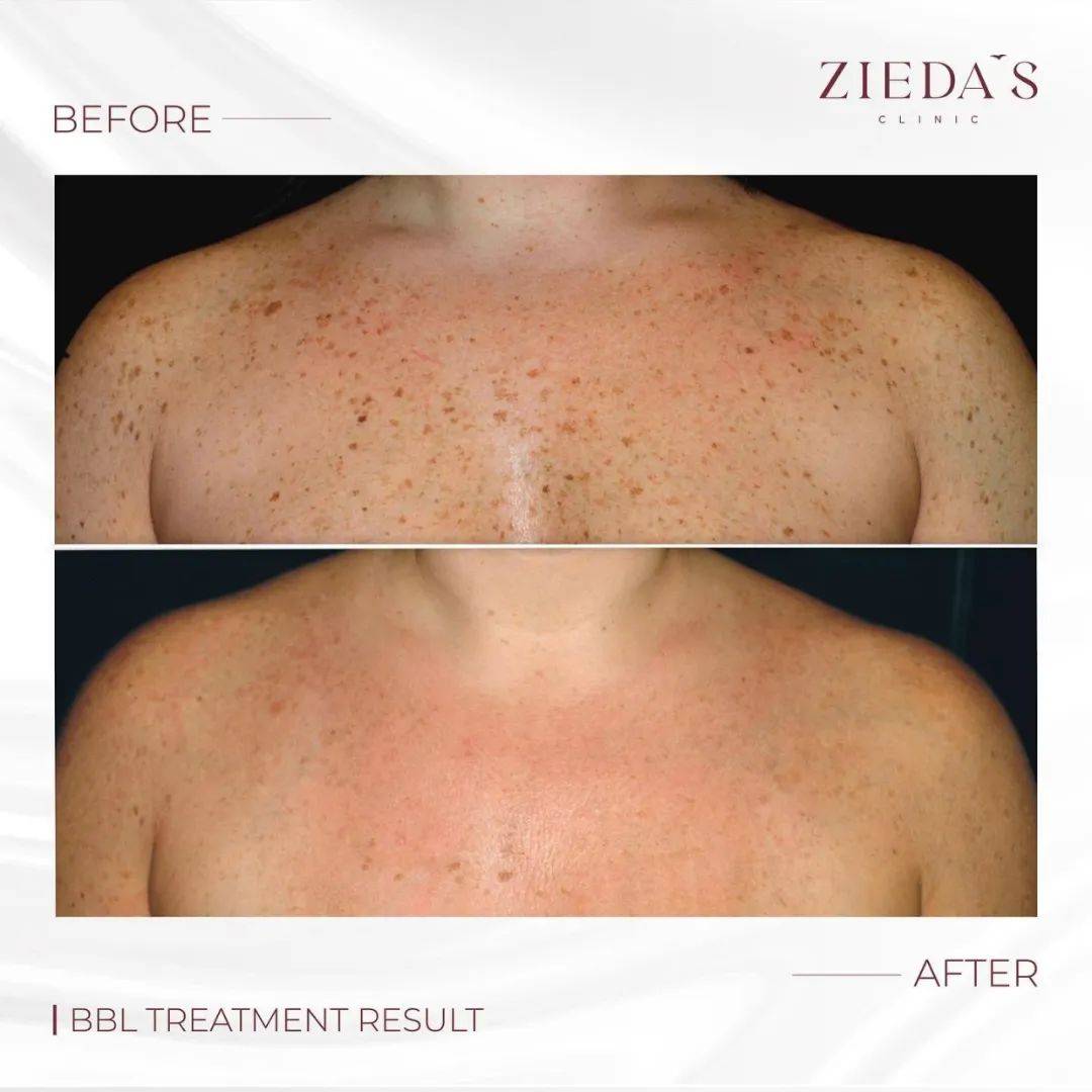 夏天脸油腰粗怎么办?躺平也能美!