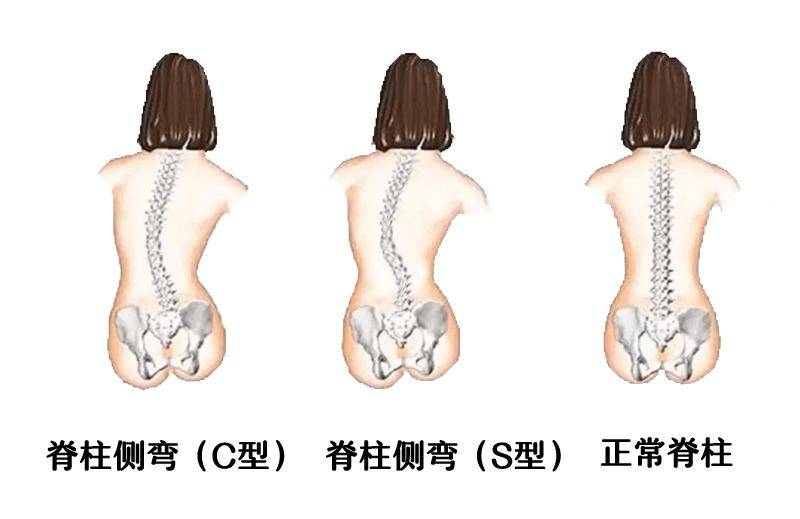 胸椎后凸正常范围图片