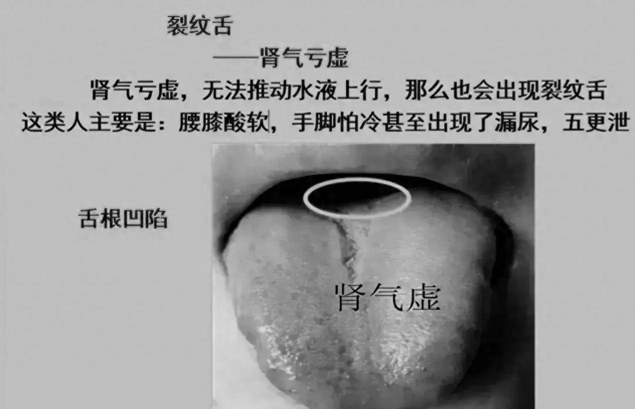 出现裂纹舌最常见的10大原因,一一为你解答!