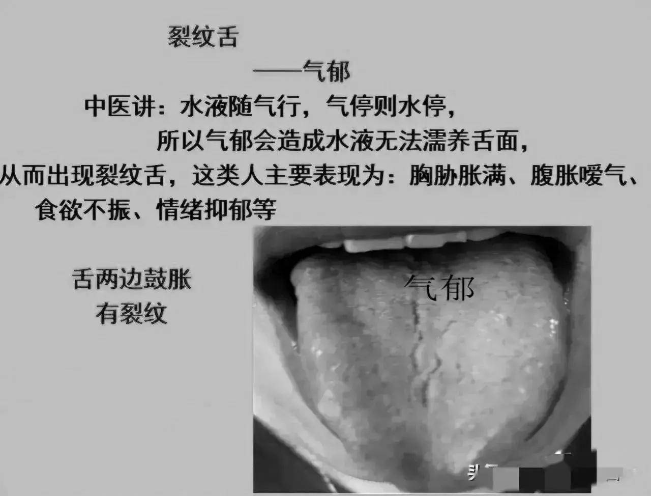 出现裂纹舌最常见的10大原因,一一为你解答!