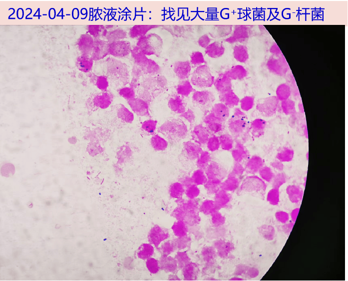 探案丨汹涌的腹股沟脓液背后_腰部_臀部_大腿