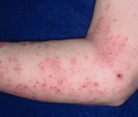 【健康科普】湿疹不可怕,让我来帮您!