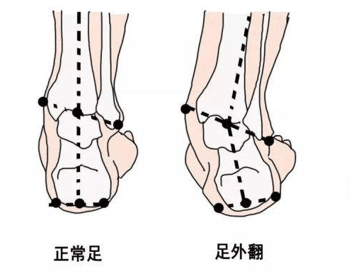 29全国爱足日丨关注健康,从足做起_足部_治疗_手术