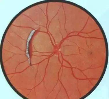 超经典19张眼底病变对照分析图【适合教学医生必收藏】_视网膜_视频