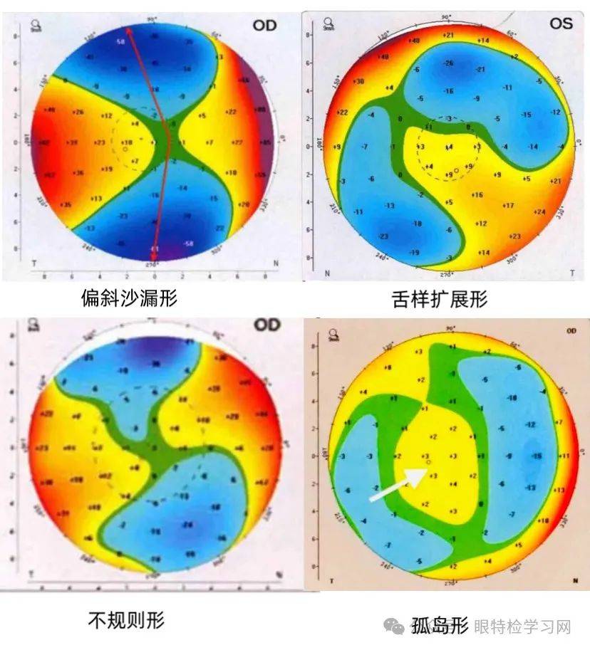 角膜地形图上看kappa角图片