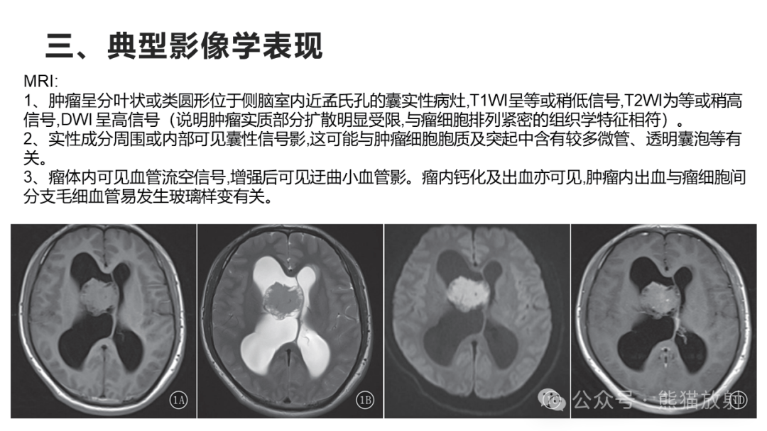 侧脑室肿瘤图片