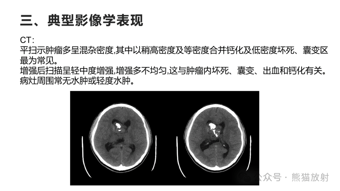 侧脑室影像图片图片