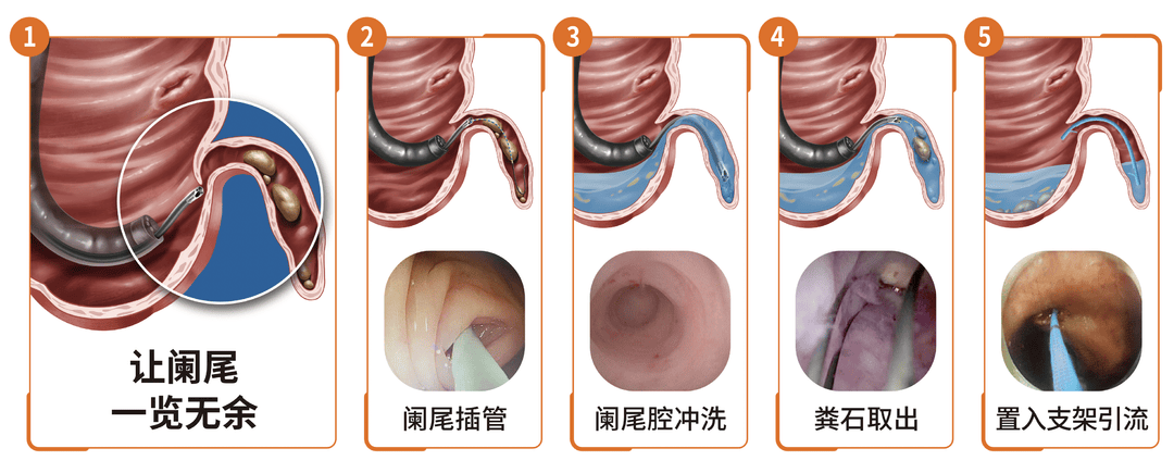 腹腔镜阑尾炎三个孔图片