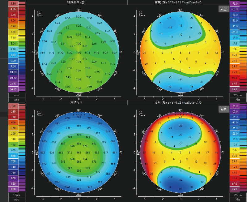 角膜地形图上看kappa角图片