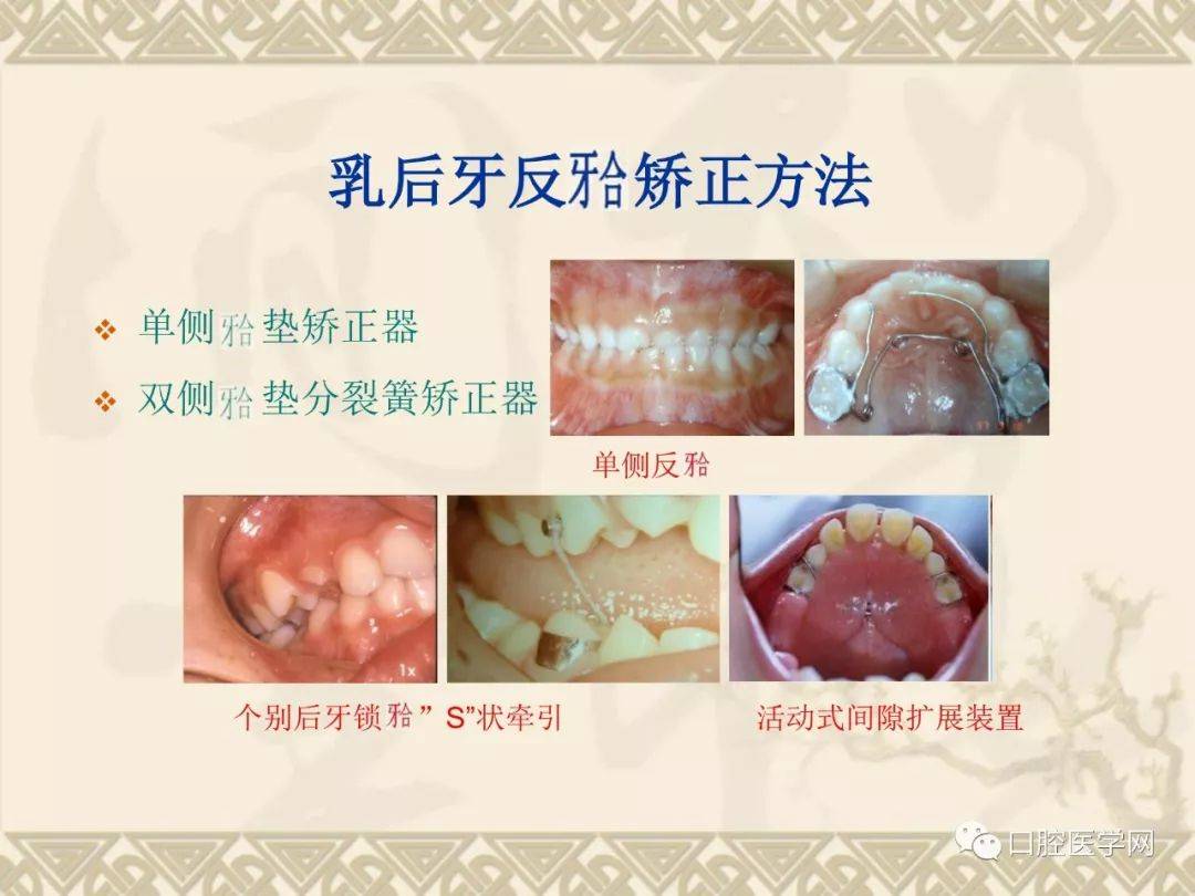 儿童间隙保持器弊端图片