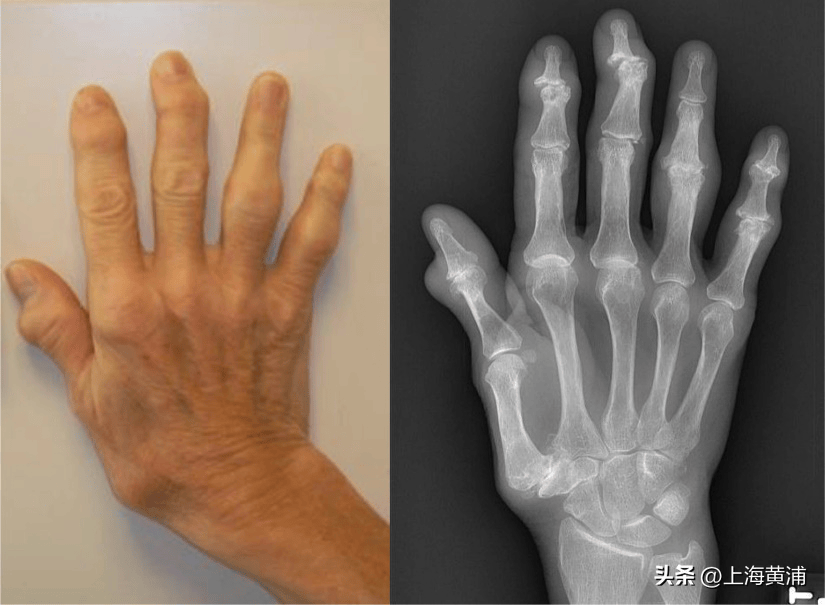 勿把骨关节炎当成类风湿