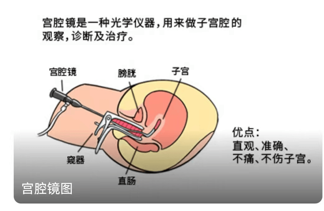 自己检查宫颈的方法图片