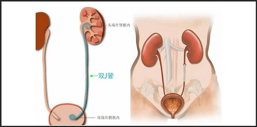 双j管 放置图片