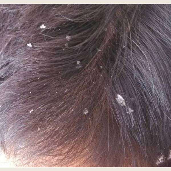 青少年去屑止痒洗发水?去屑养头皮的洗发水推荐