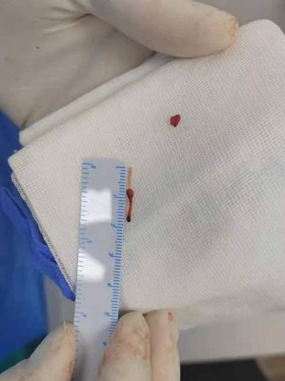 在血管里漂移5年后取出 陕西一男婴输液时针头导管断裂